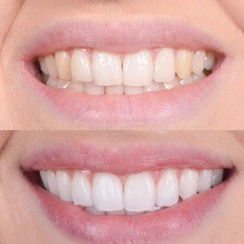 WhiteLuxe Quick teeth whitening for a dazzling smile