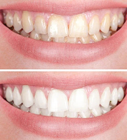 1+1 FREE | GlowWhite - Teeth Whitener