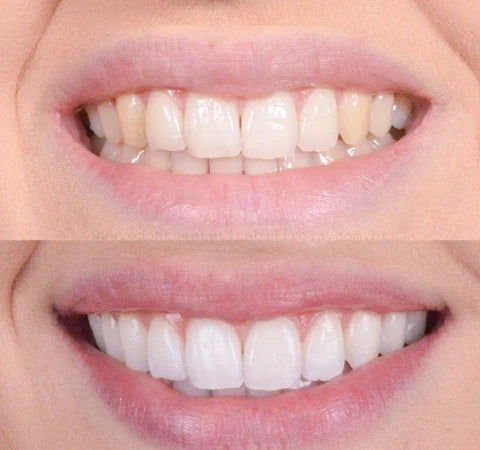 1+1 FREE | GlowWhite - Teeth Whitener