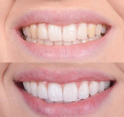 1+1 FREE | GlowWhite - Teeth Whitener